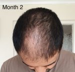 Medikemos hair transplant1.jpg