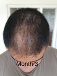 Medikemos hair transplant2.jpg