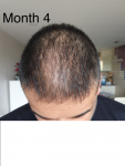 Medikemos hair transplant3.png
