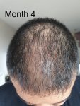 Medikemos hair transplant4.jpg