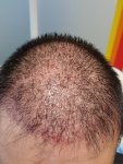 Medikemos hair transplant 1.jpg