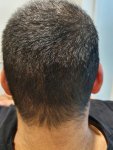 Medikemos hair transplant2.jpg