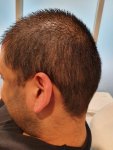 Medikemos hair transplant 3.jpg