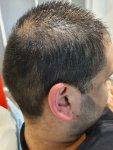 Medikemos hair transplant4.jpg