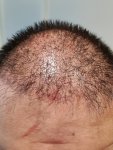 Medikemos hair transplant 5.jpg