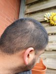 Hair transplant with Dr Lupanzula1.jpg