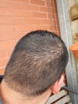 Hair transplant with Dr Lupanzula2.jpg