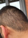 Hair transplant with Dr Lupanzula3.jpg