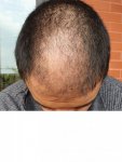 Hair transplant with Dr Lupanzula4.jpg