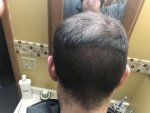 Hair transplant donor area.jpeg