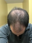 hair transplant.jpeg