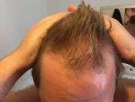 Frontal hair loss.jpeg