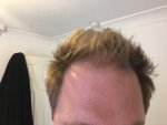 Frontal hair loss - hair thinning.jpeg
