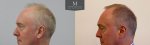 ID1624_Before_After_left.jpg
