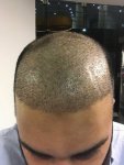 turkey-hair-transplant-before -after.jpg turkey-hair-transplant-before -after.jpg