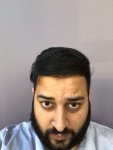 Cosmedica 1 year post op hair transplant..jpg Cosmedica 1 year post op hair transplant..jpg