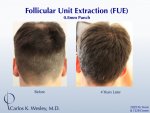 Dr Carlos Wesley Hair Transplant7.jpeg Dr Carlos Wesley Hair Transplant7.jpeg