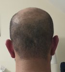 Donor Area Hair restoration..jpg Donor Area Hair restoration..jpg