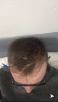 Dr Lupanzula FUE Hair Transplant1.png Dr Lupanzula FUE Hair Transplant1.png