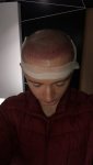 Dr Lupanzula FUE Hair Transplant2.jpeg Dr Lupanzula FUE Hair Transplant2.jpeg