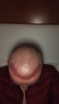 Dr Lupanzula FUE Hair Transplant3.jpeg Dr Lupanzula FUE Hair Transplant3.jpeg