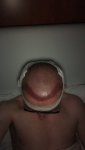 Dr Lupanzula FUE Hair Transplant4.jpeg Dr Lupanzula FUE Hair Transplant4.jpeg