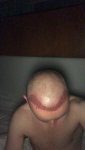 Dr Lupanzula FUE Hair Transplant5.jpeg Dr Lupanzula FUE Hair Transplant5.jpeg