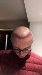 Dr Lupanzula FUE Hair Transplant6.jpeg Dr Lupanzula FUE Hair Transplant6.jpeg