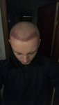 Dr Lupanzula FUE Hair Transplant7.jpeg Dr Lupanzula FUE Hair Transplant7.jpeg