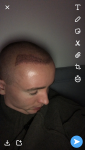 Dr Lupanzula FUE Hair Transplant8.png Dr Lupanzula FUE Hair Transplant8.png