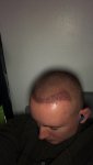 Dr Lupanzula FUE Hair Transplant9.jpeg Dr Lupanzula FUE Hair Transplant9.jpeg