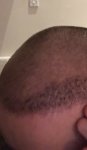 Dr Lupanzula FUE Hair Transplant10.jpeg Dr Lupanzula FUE Hair Transplant10.jpeg