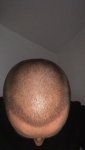 Dr Lupanzula FUE Hair Transplant11.jpeg Dr Lupanzula FUE Hair Transplant11.jpeg