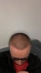 Dr Lupanzula FUE Hair Transplant12.jpeg Dr Lupanzula FUE Hair Transplant12.jpeg