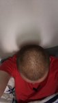 Dr Lupanzula FUE Hair Transplant14.jpeg Dr Lupanzula FUE Hair Transplant14.jpeg