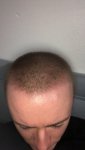 Dr Lupanzula FUE Hair Transplant15.jpeg Dr Lupanzula FUE Hair Transplant15.jpeg