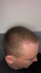 Dr Lupanzula FUE Hair Transplant16.jpeg Dr Lupanzula FUE Hair Transplant16.jpeg