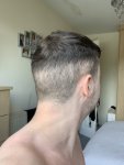 bad hair transplant at Clinic Center Turkey.jpeg