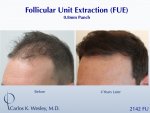 Dr Carlos Wesley hair transplant result1.jpeg Dr Carlos Wesley hair transplant result1.jpeg
