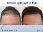 Dr Carlos Wesley hair transplant result2.jpeg Dr Carlos Wesley hair transplant result2.jpeg
