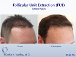 Dr Carlos Wesley hair transplant result3.jpeg Dr Carlos Wesley hair transplant result3.jpeg