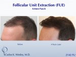 Dr Carlos Wesley hair transplant result4.jpeg Dr Carlos Wesley hair transplant result4.jpeg