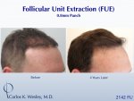 Dr Carlos Wesley hair transplant result5.jpeg Dr Carlos Wesley hair transplant result5.jpeg