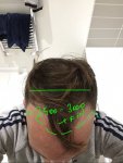 Dr Koray Erdogan - Asmed hair transplant1.jpeg