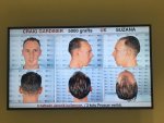 Dr Koray Erdogan - Asmed hair transplant2.jpeg