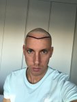 Dr Koray Erdogan - Asmed hair transplant3.jpeg