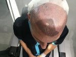 Dr Koray Erdogan - Asmed hair transplant4.jpeg