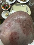 Dr Koray Erdogan - Asmed hair transplant6.jpeg