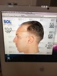 Dr Koray Erdogan - Asmed hair transplant7.jpeg