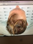 Dr Koray Erdogan - Asmed hair transplant8.jpeg